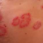 Curar la psoriasis es posible con estos consejos