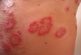 Curar la psoriasis es posible con estos consejos