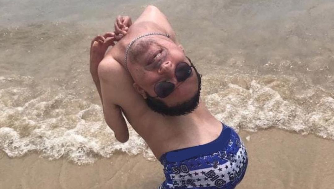 Claudio, hombre que nació con la cabeza al revés, se infecta de #COVID